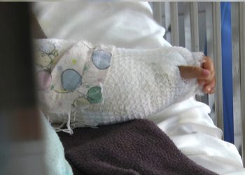 Emiten recomendaciones para evitar quemaduras en niños