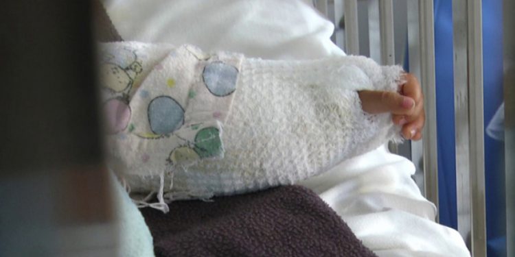 Emiten recomendaciones para evitar quemaduras en niños