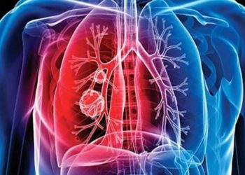 Foto: Ilustrativa de la tuberculosis.