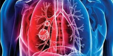 Foto: Ilustrativa de la tuberculosis.