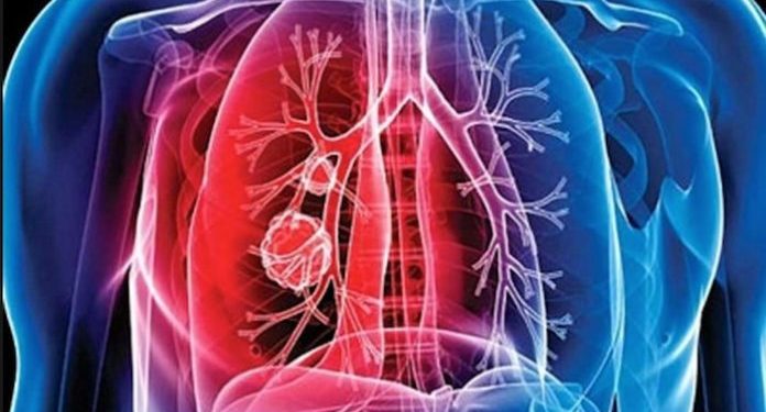 Ministerio de Salud mantiene acciones contra la tuberculosis en Retalhuleu