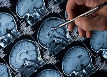 Biosensor abre las puertas a la detección temprana del alzhéimer