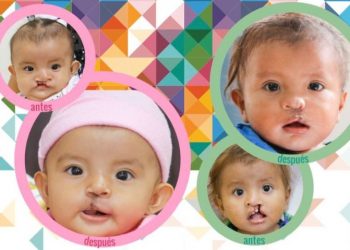 Implementarán jornada de cirugías gratuitas de paladar hendido y labio leporino