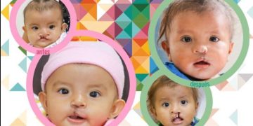 Implementarán jornada de cirugías gratuitas de paladar hendido y labio leporino