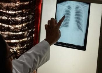 Muertes globales por tuberculosis subieron por primera vez en una década