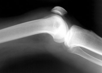 La médula ósea está implicada en el desarrollo de la aterosclerosis