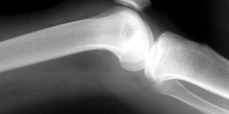 La médula ósea está implicada en el desarrollo de la aterosclerosis