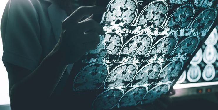 Crean sonda que emplea la luz para diagnosticar patologías cerebrales