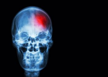 El ictus cerebral mata las neuronas mediante ondas eléctricas letales