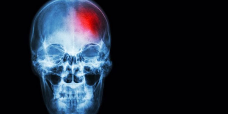 El ictus cerebral mata las neuronas mediante ondas eléctricas letales