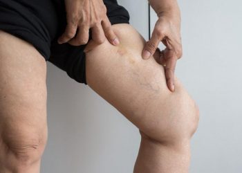 Salud emite recomendaciones para evitar retención de líquidos