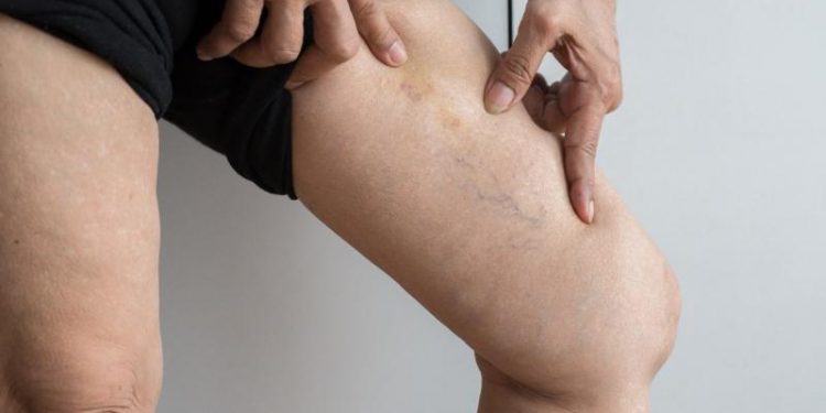 Salud emite recomendaciones para evitar retención de líquidos