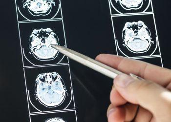 Salud detalla cómo identificar los tumores cerebrales.