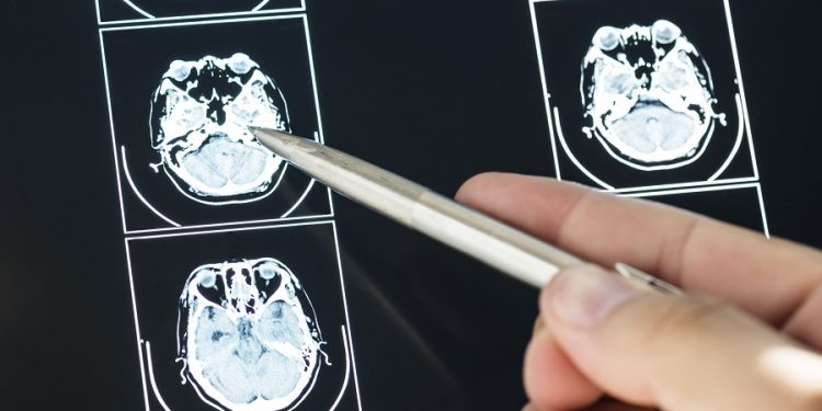 Salud detalla cómo identificar los tumores cerebrales.