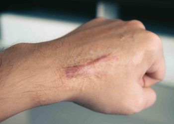 Conozca las señales para identificar la piel queloide