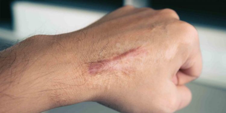 Conozca las señales para identificar la piel queloide