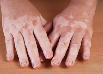 Conozca más sobre el vitíligo