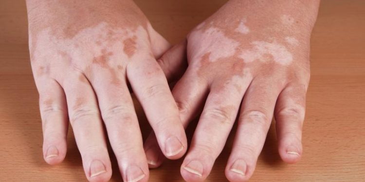 Conozca más sobre el vitíligo