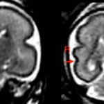 Beber en el embarazo, incluso poco, produce cambios en el cerebro del bebé