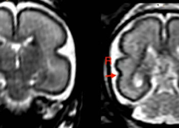 Beber en el embarazo, incluso poco, produce cambios en el cerebro del bebé
