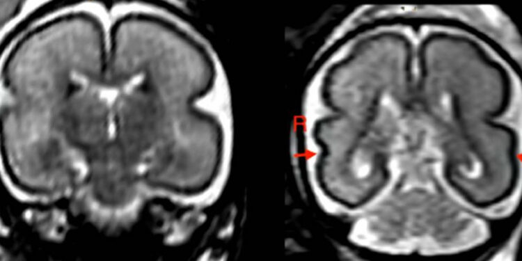 Beber en el embarazo, incluso poco, produce cambios en el cerebro del bebé