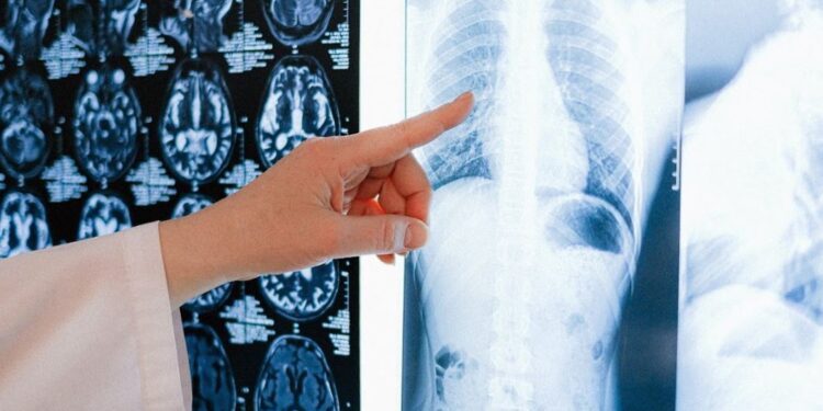 Hacen un llamado a prevenir enfermedad pulmonar obstructiva crónica