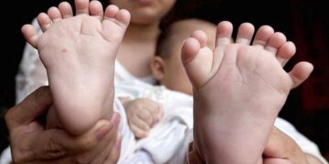 Síndrome de Edwards, un padecimiento mortal