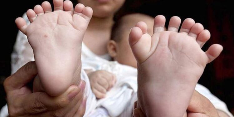 Síndrome de Edwards, un padecimiento mortal