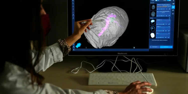 Zonas del cerebro dañadas por la hipertensión afectan en la demencia