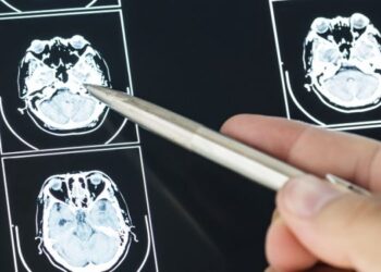 Logran que la quimioterapia penetre en el cerebro contra un tumor mortal