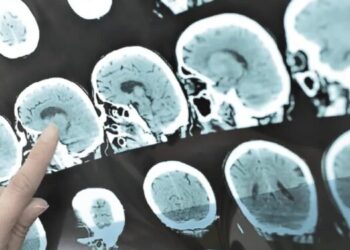 El desequilibrio neuroquímico afecta dos áreas frontales del cerebro.