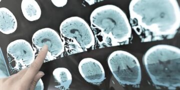 El desequilibrio neuroquímico afecta dos áreas frontales del cerebro.