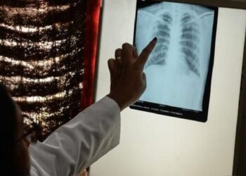 Conforman red pediátrica de tuberculosis en el país