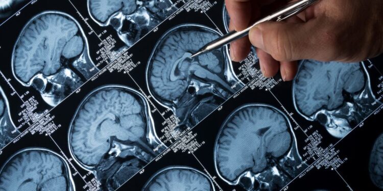 Descubren la primera transmisión accidental del alzhéimer