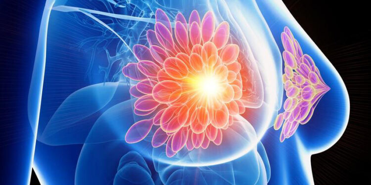 Investigan nueva terapia contra el cáncer de mama. / Foto: Bagó.