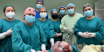 Médicos con el tumor gigante ovárico extraído. / Foto: MSPAS.