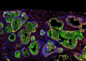 Hallazgo de proteína en el páncreas podría llevar a encontrar cura para ese tipo de tumores.