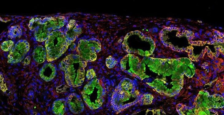 Hallazgo de proteína en el páncreas podría llevar a encontrar cura para ese tipo de tumores.
