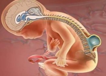 Mutación genética aumenta el riesgo de espina bífida.