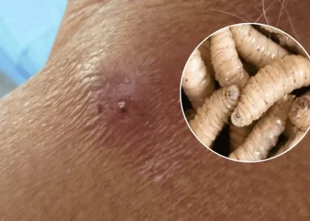 Gusano barrenador también afecta a los humanos. / Foto: Telemetro.