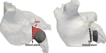 Gemelos digitales digitales del corazón para simular cirugías y establecer escenarios en pacientes con arritmias.