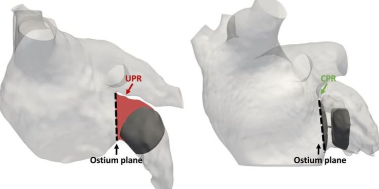 Gemelos digitales digitales del corazón para simular cirugías y establecer escenarios en pacientes con arritmias.