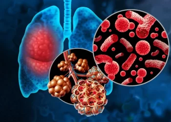 La neumonía ataca el sistema pulmonar. / Imagen: CuídatePlus.