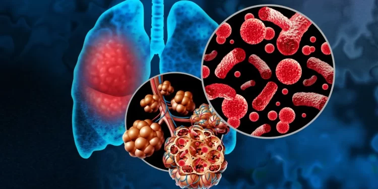 La neumonía ataca el sistema pulmonar. / Imagen: CuídatePlus.