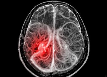 Este tipo de tumores cerebrales no pueden extirparse quirúrgicamente.