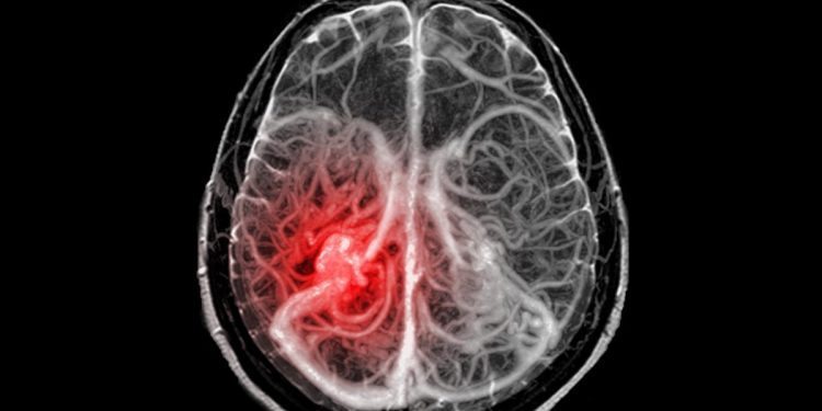 Este tipo de tumores cerebrales no pueden extirparse quirúrgicamente.