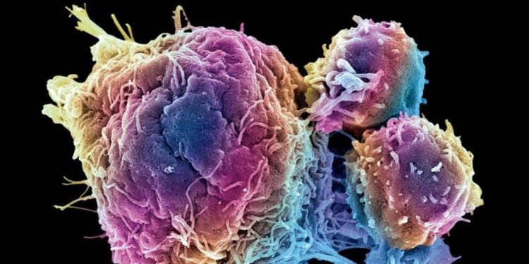 Células grasas modificadas muestran capacidad para absorver el cáncer.