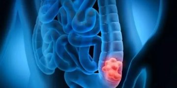 Demuestran que la inmunoterapia es eficaz contra el cáncer colorrectal es uno de los más mortales.