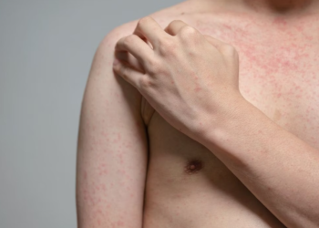 México enfrenta brote de sarampión. / Foto: internet, Heute.