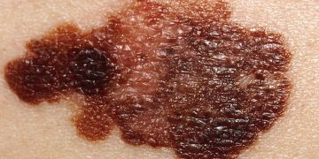 Melanoma. / Foto: Wikipedia.